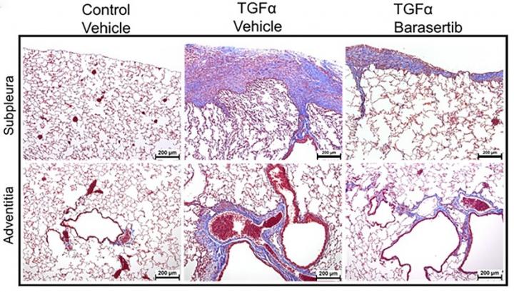 Pulmonary fibrosis treatment shows proof of principle